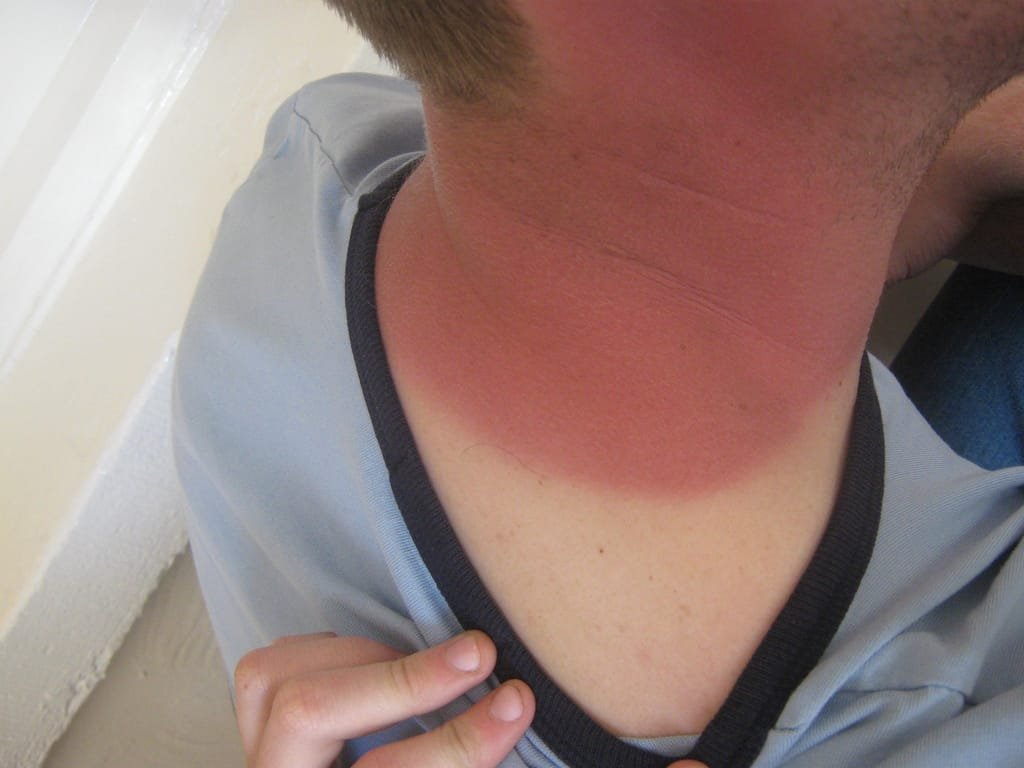 sunburn neck